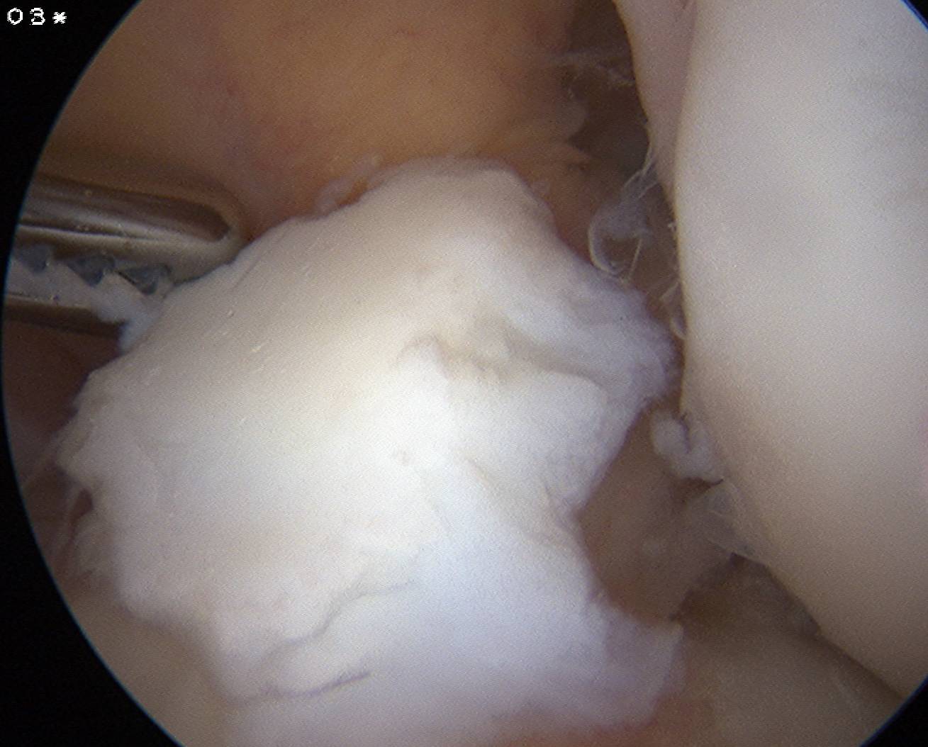 Chondral Lesion Post ACL Injury
